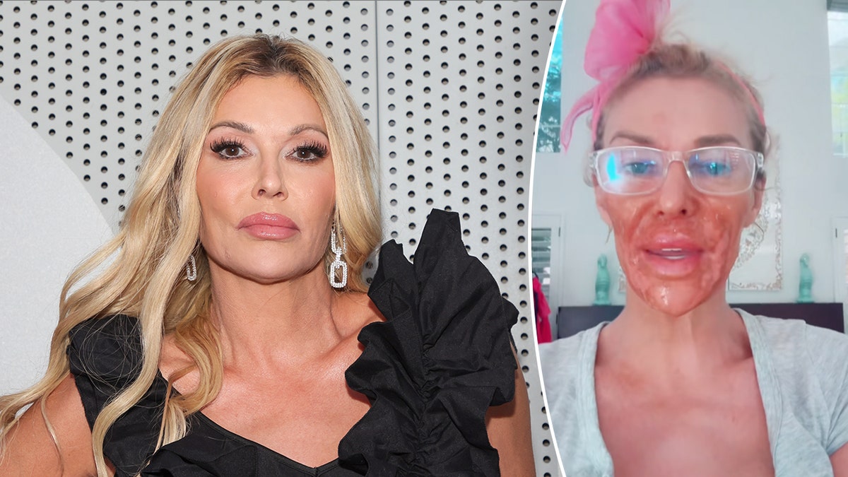 Brandi Glanville before and after face damage